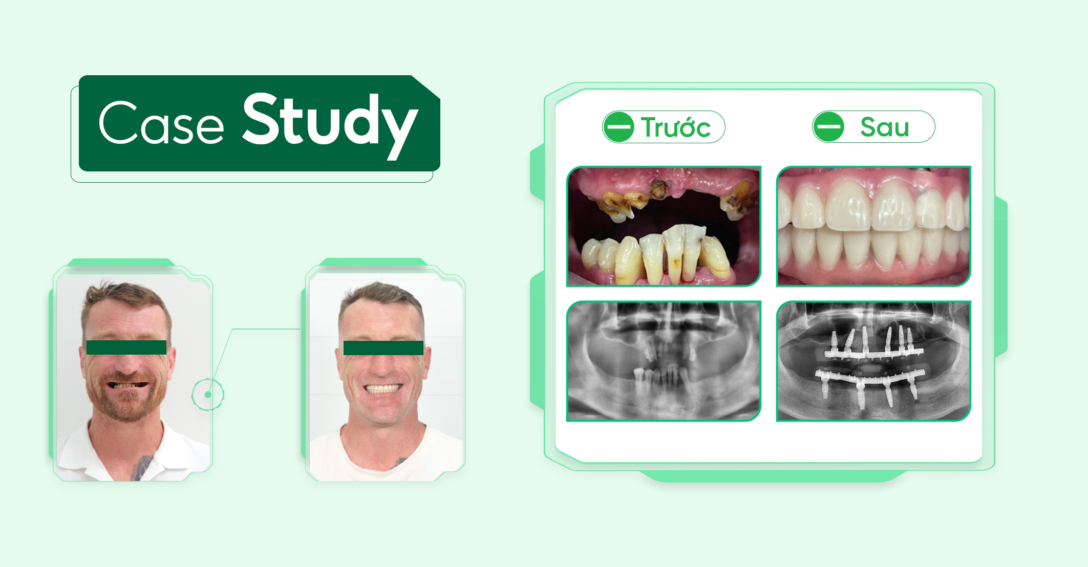 Case-implant-all-on ( 1 )