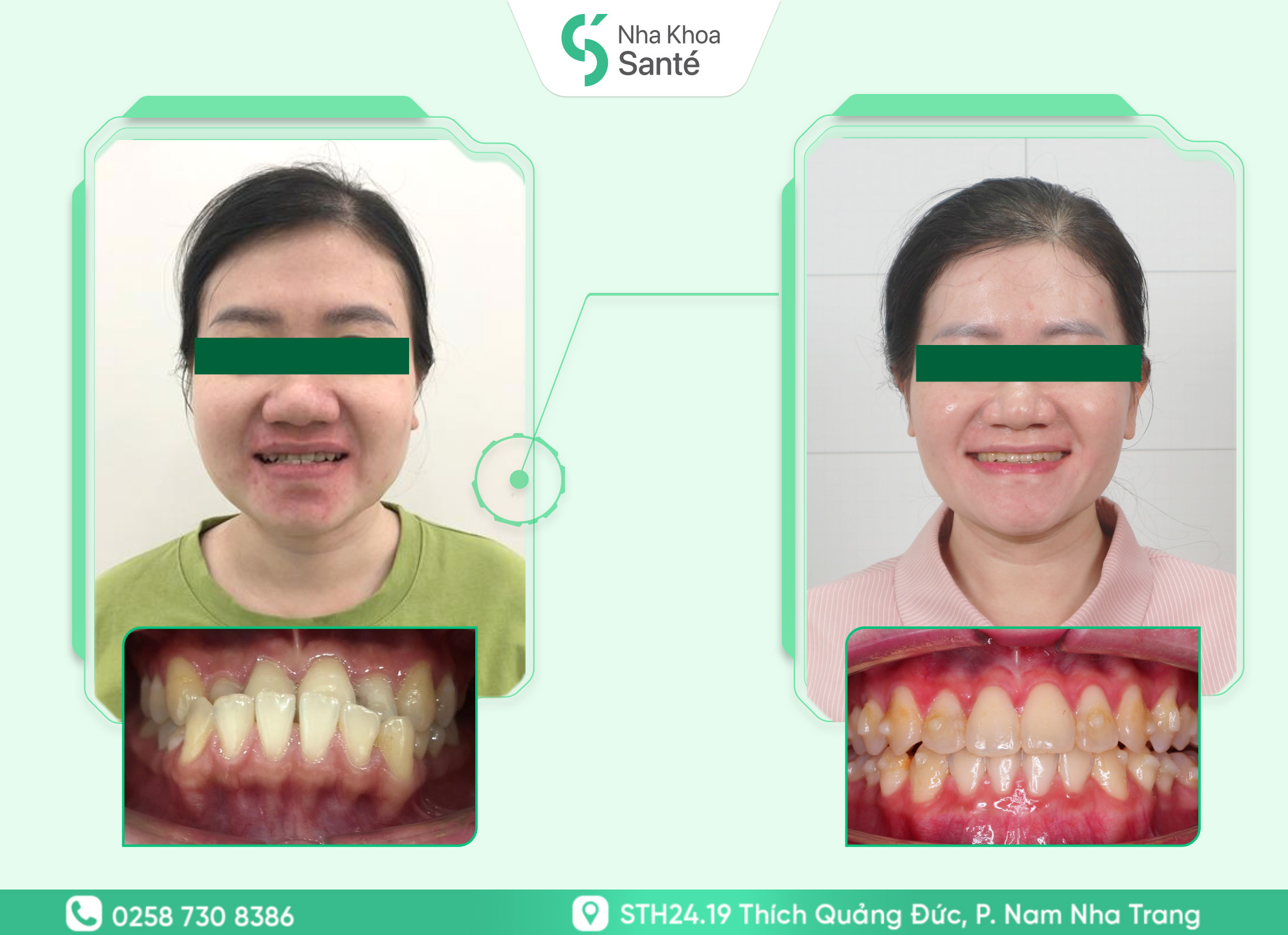 Case-invisalign (1)