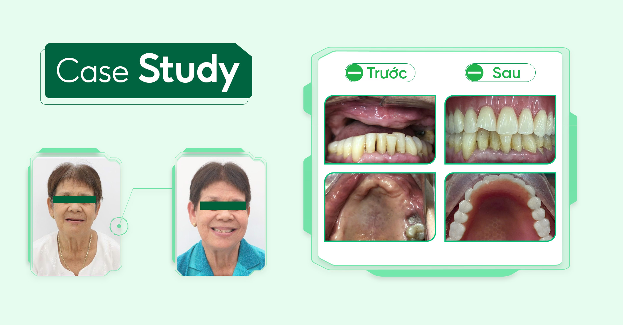 Case-phuc-hinh-thao-lap ( 1 )